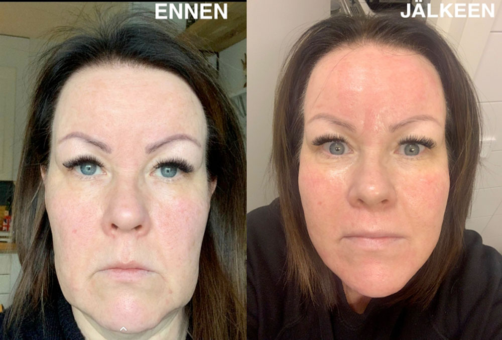 high kasvojenkohotus ennen ja jälkeen